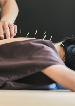 Acupuncture